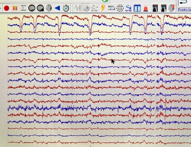 Skærmbillede af EEG fra Epilepsihospitalets EMU